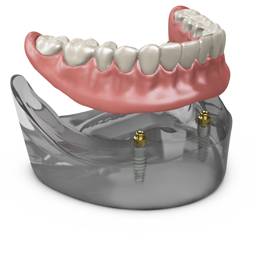 ODSecure Removable Full-Arch Model