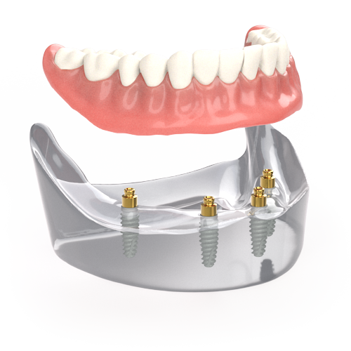 OD Secure Removable Full-Arch 4 implant