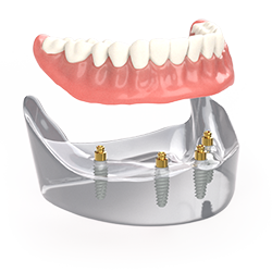 Picture of ODSecure Patient Education Model, 4 Implants