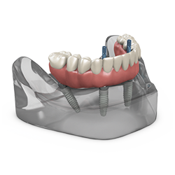 Modell feste Ganzkieferprothese von TeethXpress