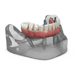 Picture of TeethXpress Patient Education Model