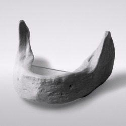 Picture of Edentulous mandible including mounting plate