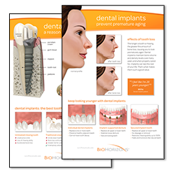Picture of Dental Implants-Patient Ed. Posters, 2 pack