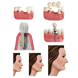 Picture of Missing Teeth Images