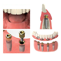 Picture of Edentulous Images