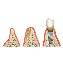 Picture of Bone Grafting Images