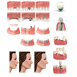 Picture of Tooth Replacement Option Images