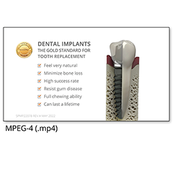 Picture of Dental Implant Tooth vs. Natural Tooth Patient Animation - English